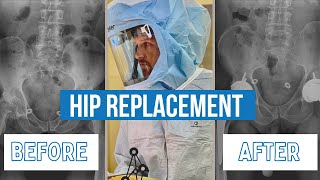 Hip Replacement Strategy for 2023
