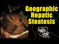 Geographic Hepatic Steatosis || Focal Fatty Infiltration || Ultrasound || Case 159