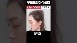 모발이식 1년 후 여성헤어라인모발이식 절개식 2500모 #shorts