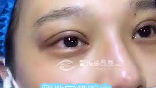 雙眼皮的做法，香港做雙眼皮哪裡好？