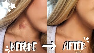 How To Get Rid Of Hickeys In Two EASY Steps! (no color correcting) | Brooklyn Anne