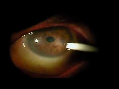 How painful is corneal debridement?