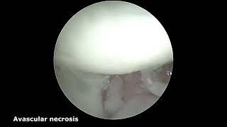 Arthroscopic Midcarpal Tendon Interposition