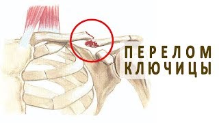 Симптомы и лечение перелома ключицы