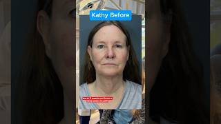 The Real Facelift Results After 3 Weeks (Interview)