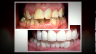 Teeth Bleaching San Francisco, CA | Call (415) 392-2072