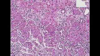 Histopathology Esophagus --Herpes esophagitis