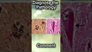 Pathology of alzheimers disease. Diagnosis in 15 seconds?#neetpg #fmge