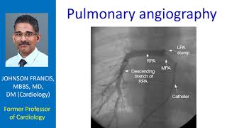 Pulmonary angiography