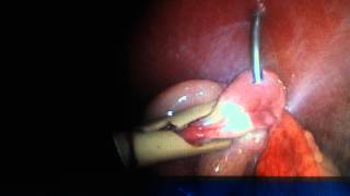 Laparoscopic ovariectomy by using Karl Stoz robi plus bipolar forcep