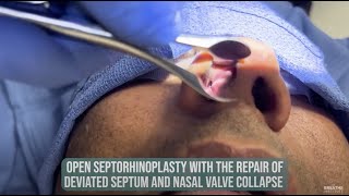 SURGICAL VID - Open Septoplasty + rhinoplasty correcting severely deviated septum - Dr. Zaghi at TBI