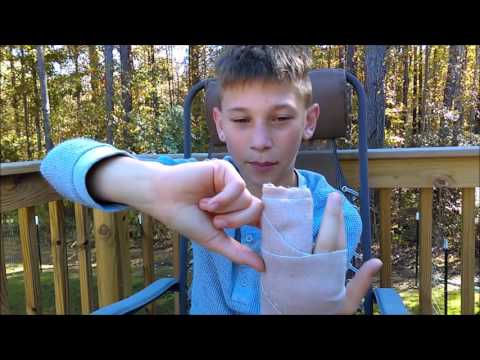 How I Broke My Knuckle How I Broke My Knuckle