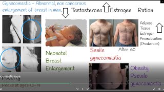 Understanding Gynecomastia.  Gynecomastia Causes and Types