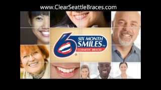 Seattle 6 Month Braces