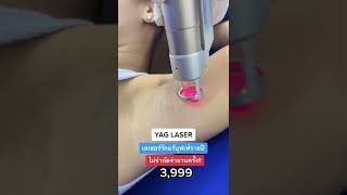 กำจัดขนเลเซอร์ด้วย Yag laser #charmerclinic #yaglaser #เลเซอร์ขน