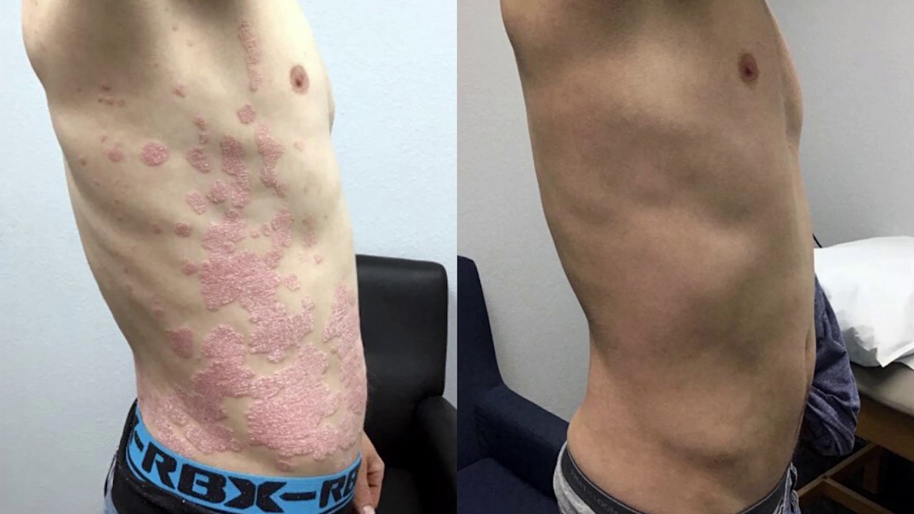 Psoriasis Treatment With Before And After Photos - YouTube