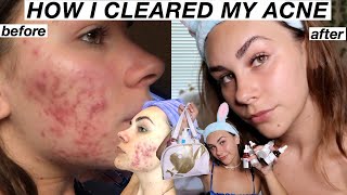 HOW I CLEARED MY SKIN AND ACNE SCARS  *fungal and hormonal cystic acne journey*