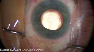 Eugene Eyecare Live Cataract Surgery