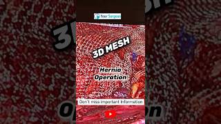 3D mesh I Hernia Operation I Hernia ki NET I Best Hernia Net Kaunsi hai ? herniya ka operation