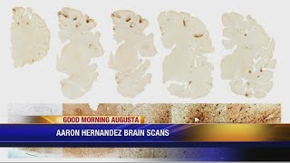 Brain scans of Aaron Hernandez