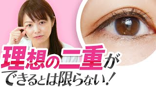 【二重埋没法】必ず理想の形に出来るは間違い!?デメリットを解説！