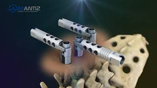 QUATTRO - GADGE MIS Percutaneous Screw System _ Screw Extender