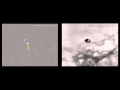 Transcirculation balloon-assisted stent-supported coil embolization of a basilar tip aneurysm