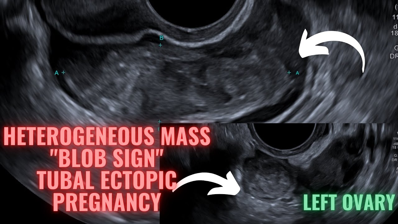 Ultrasound Pregnancy Tubal Ectopic Pregnancy (Blob Sign). Diagnosis ...