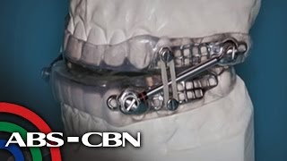 TV Patrol: Paano maiiwasan ang sleep apnea?