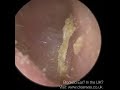 1 576 possible malignant otitis externa in diabetic patient