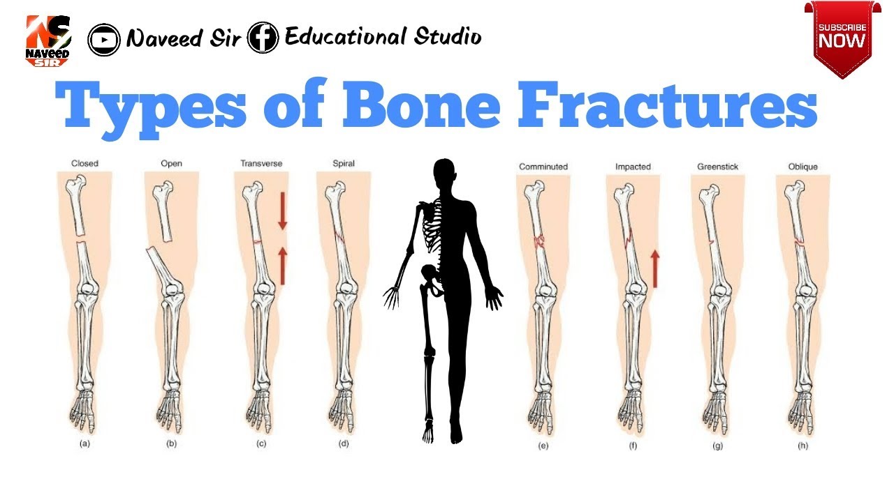 Types Of Bone Fractures - YouTube