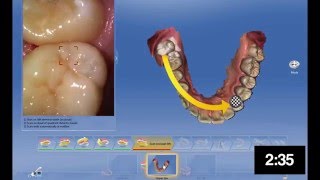 Cerec Ortho 1.1 Full Arch Live Scanning