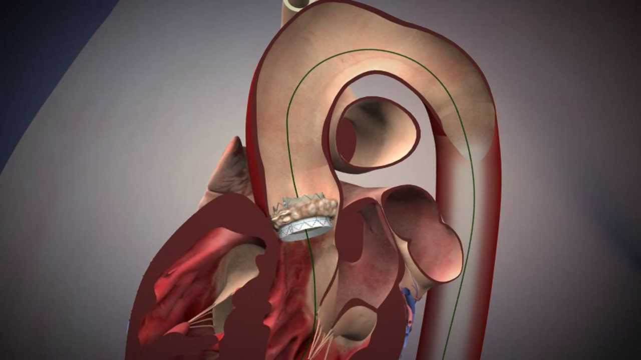 Tavr Edwards Sapien Aortic Valve Deployment Youtube