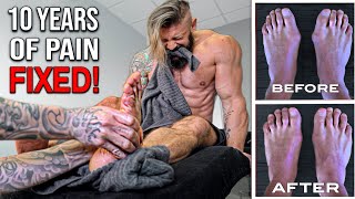 The WORST PAIN! | Fixing 10 YEARS Of Flat Feet & Bunions | AMAZING Results! (Lex Fitness)