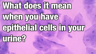 What does it mean when you have epithelial cells in your urine?