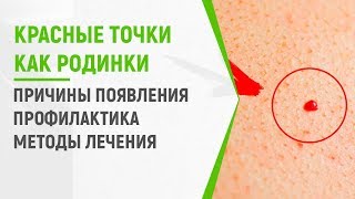 Красные точки на теле как родинки