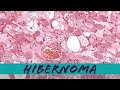 Hibernoma (benign brown fat tumor) pathology dermpath dermatology dermatopathology