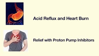 Acid Reflux: Relief with otc Proton pump inhibitors