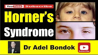 Horner's Syndrome, Dr Adel Bondok Making Anatomy Easy