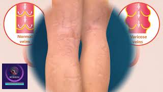 Varicose Veins Treatment | Sclerotherapy Procedure