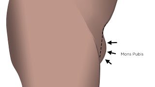 Monsplasty helps flatten the lower bulge under the belly & above the vulva; so-called FUPA removal