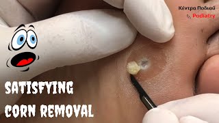 SATISFYING CORN REMOVAL| Αφαίρεση Κάλου |Ποδιατρική Ποδολογία| Ποδίατρος|Κέντρο Ποδιού Podiatry