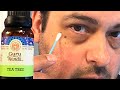 Tea Tree Oil Skin Tag Removal At Home