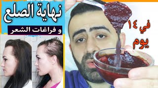 خبر مفرح اكتشفت علاج طبيعي متكامل للصلع و فراغات الشعر نتيجته تظهر خلال 14 يوم