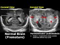 Neonatal Brain Ultrasound Normal Vs Abnormal Images | Full Term Infant & Premature Newborn Head USG