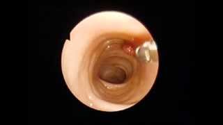 Colonoscopy - biopsy of polip