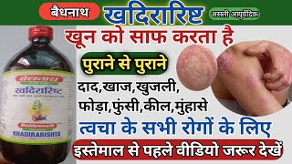 खदिरारिष्ट के फायदे/Skin disorders/ khadirarishta Benefits/side effects \u0026 Dosage review in Hindi