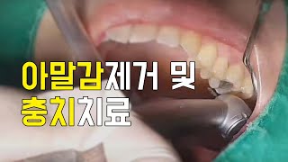 1편 - 아말감제거 및 충치치료