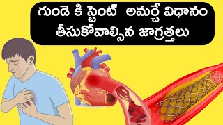 Heart stent/ గుండెలో స్టెంట్ అమర్చే విధానం