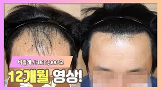 비절개 모발이식 5,000모 변화 과정 | Woomchan FUE 5,000 Hairs Change Process